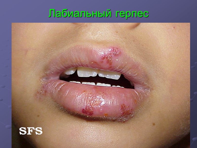 Лабиальный герпес